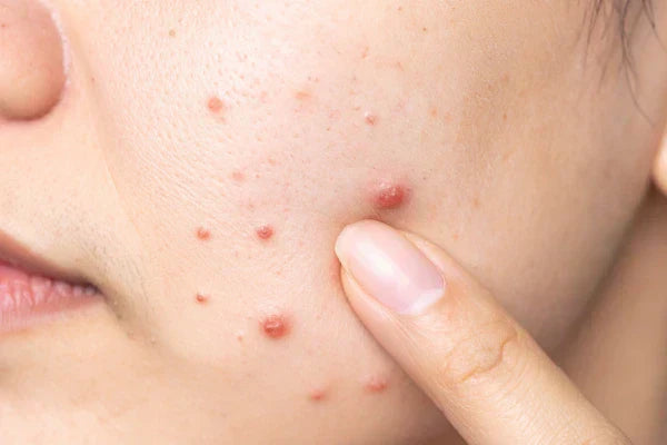 Blackheads vs. Whiteheads vs. Cystic Acne: A Complete Guide to Acne Types
