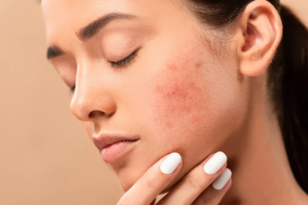 What Causes Acne? Understanding the 4 Factors Behind Every Breakout