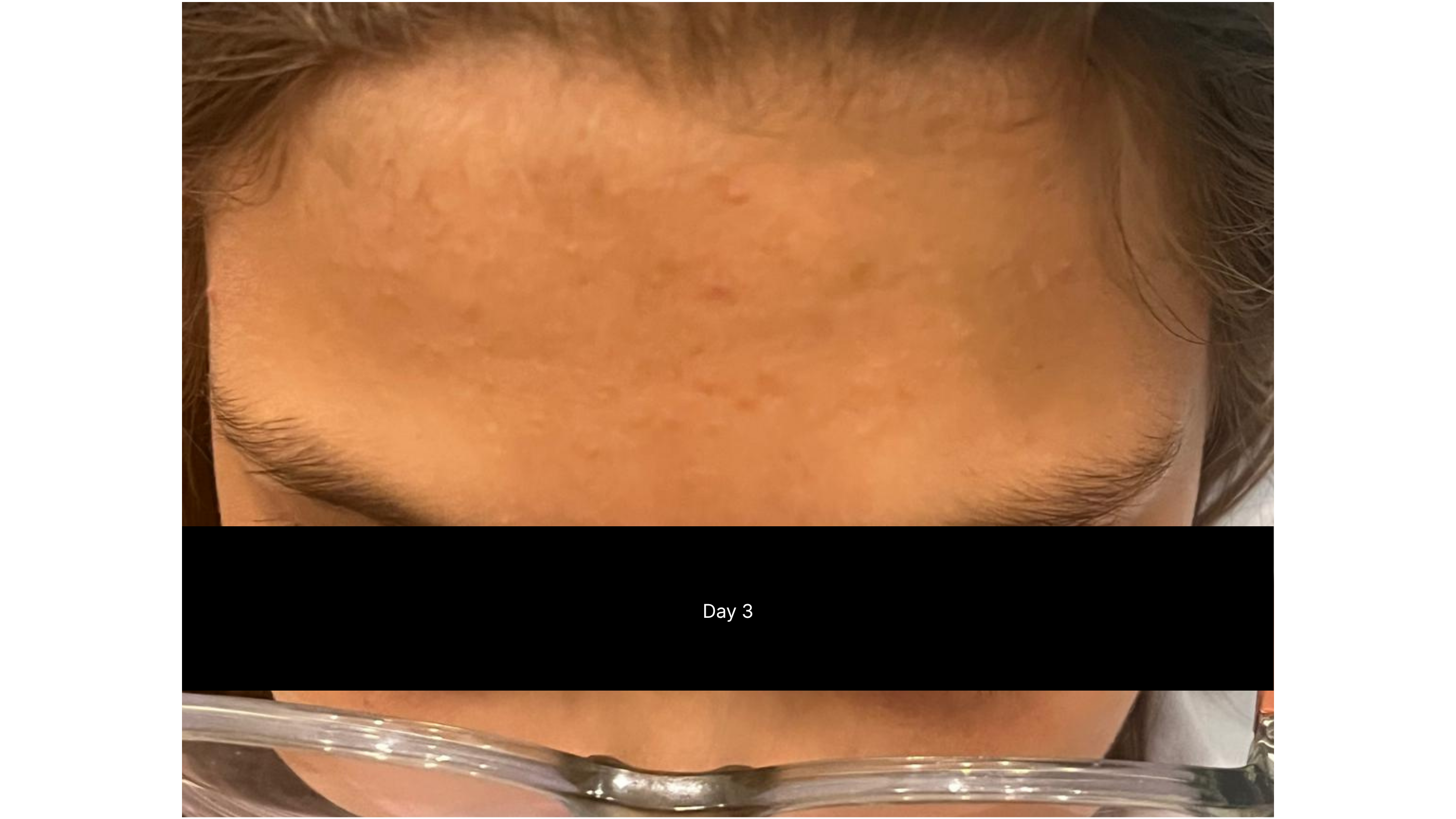 Before and after photo of a girl's forehead, showing blemishes cleared up after using CLEAR SHOT Invisible Liquid Blemish Patch for 2 days.
