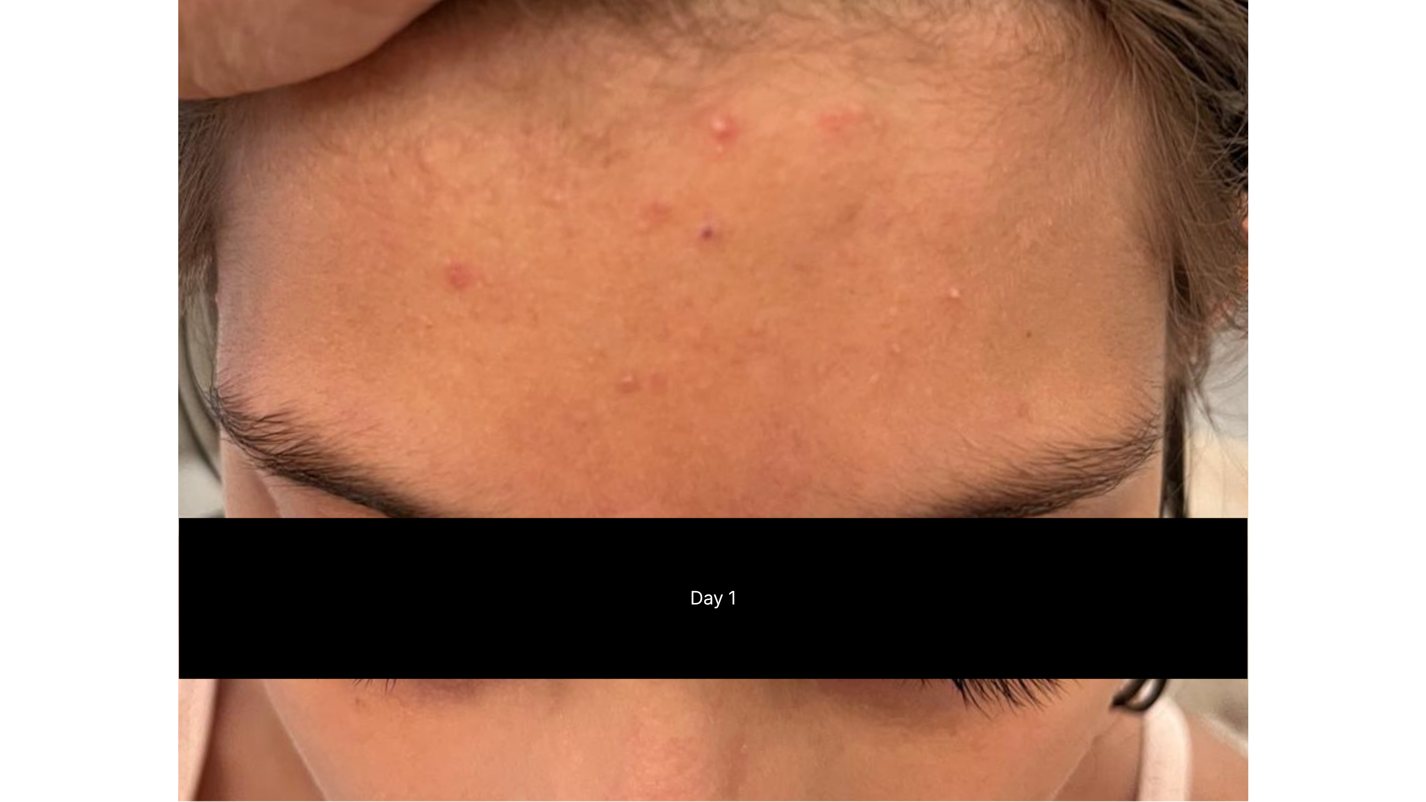 Close-up of a girl's forehead showing breakouts before using CLEAR SHOT Invisible Liquid Blemish Patch.
